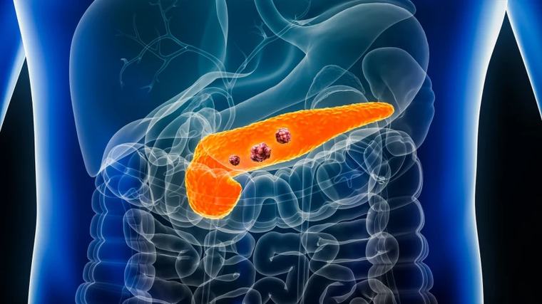 FDA zatwierdza daraxonrasib. Nowa terapia dla pacjentów z rakiem trzustki